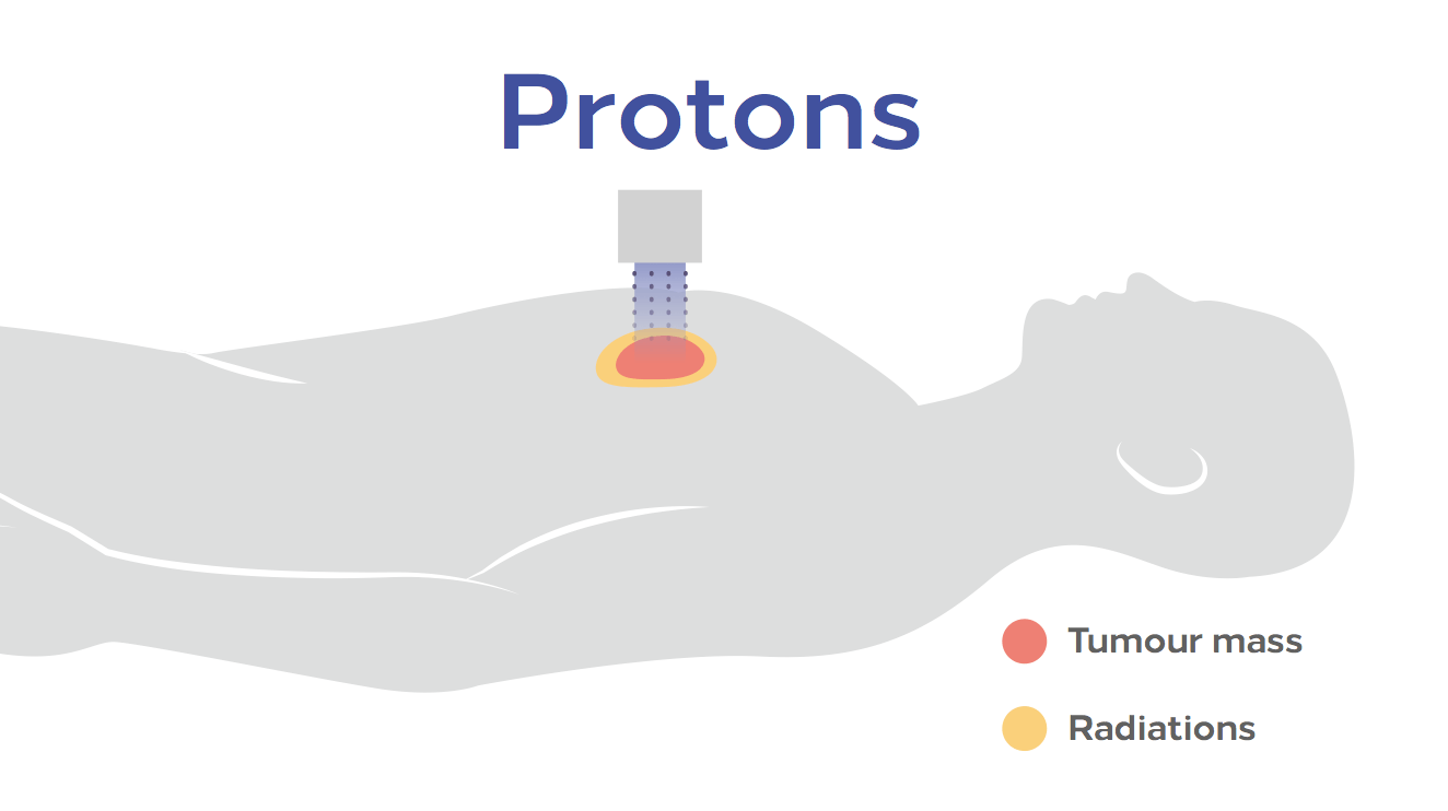 protonterapia